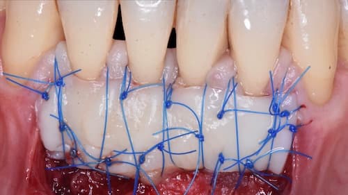 Chirurgie muco-gingivale — Dr Arthur Brincat (ICPI)