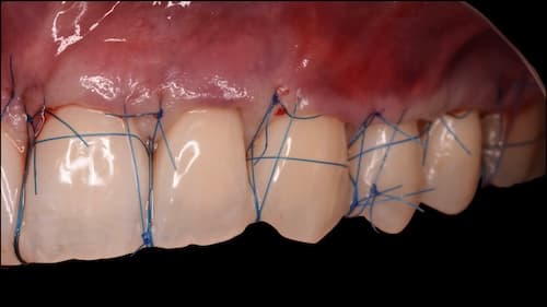 Se perfectionner en Chirurgie muco-gingivale