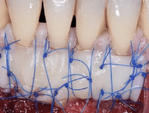 Chirurgie muco-gingivale : diagnostic et techniques de recouvrement radiculaire