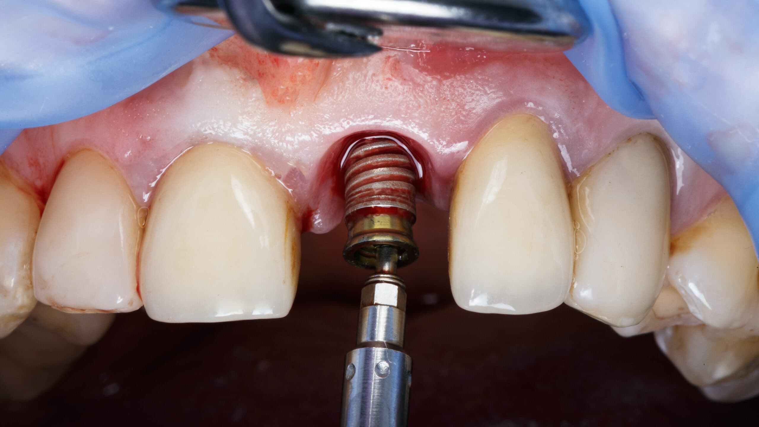 Complications en implantologie : prévention et gestion