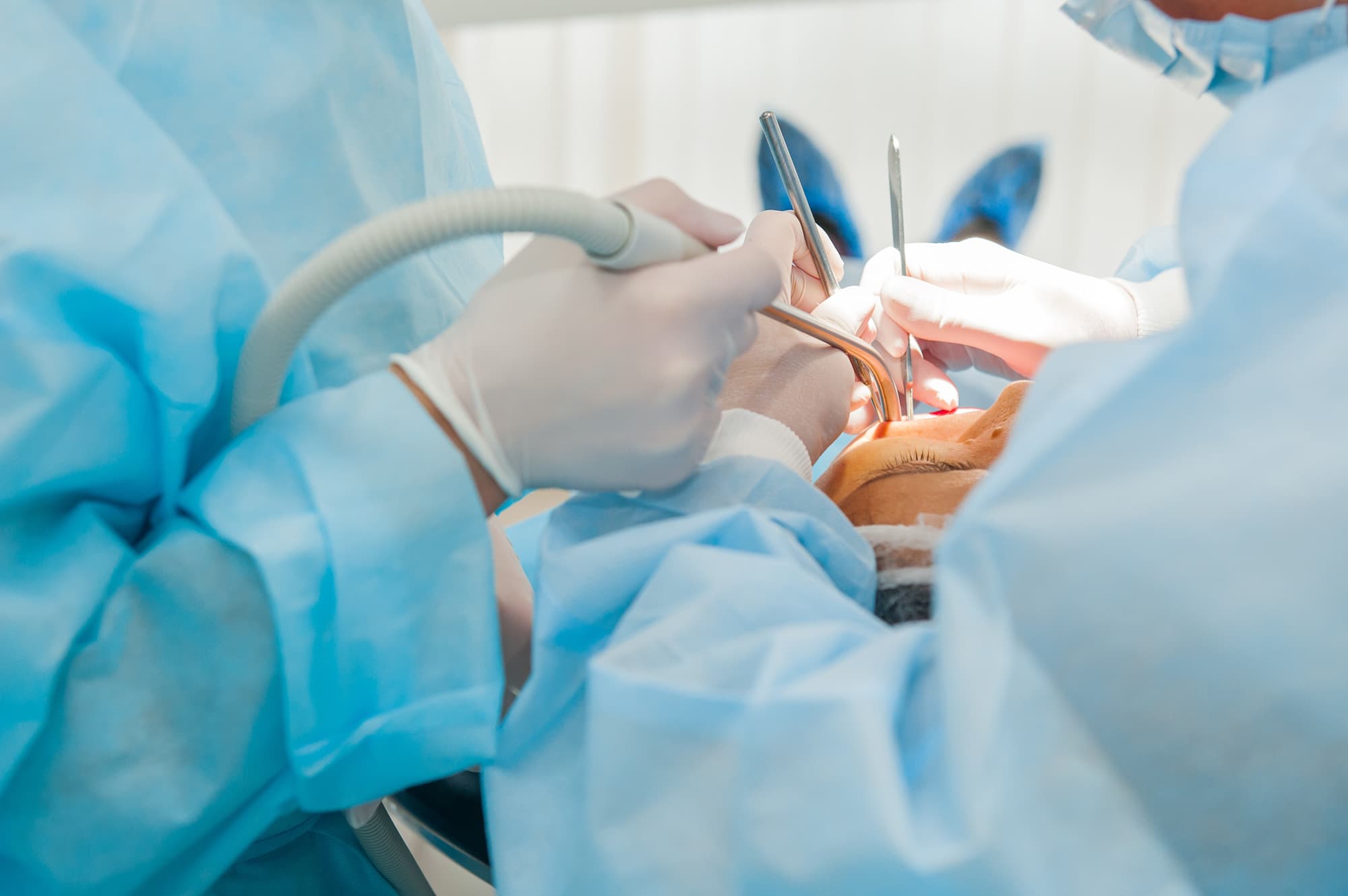 Qu'est-ce qu'une greffe de sinus ? Comprendre cette procédure essentielle en Implantologie