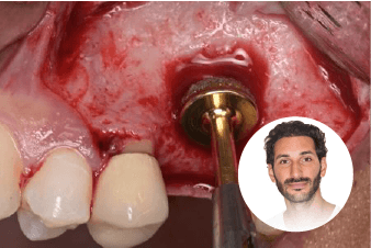 Les greffes de sinus — Dr Benjamin Attuil