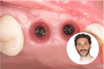 Implantologie chirurgicale — Dr Benjamin Attuil