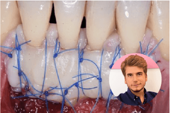 TP Chirurgie plastique parodontale et péri-implantaire